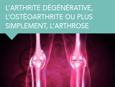 Arthrite dégénérative